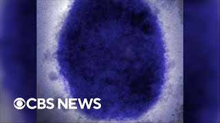 What is monkeypox?