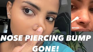 How to Get Rid of a Nose Piercing Bump FAST