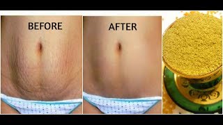 4 Ways to Get Rid of Stretch Marks|How To Remove Post Pregnancy Stretch Marks|Sushmita