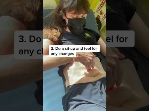 How Do I Know If I Have Diastasis Recti 🤔