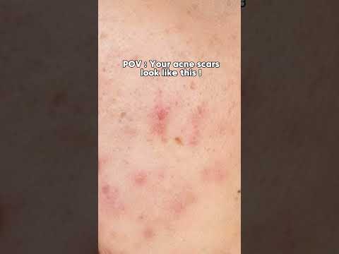 Acne scars treatment .