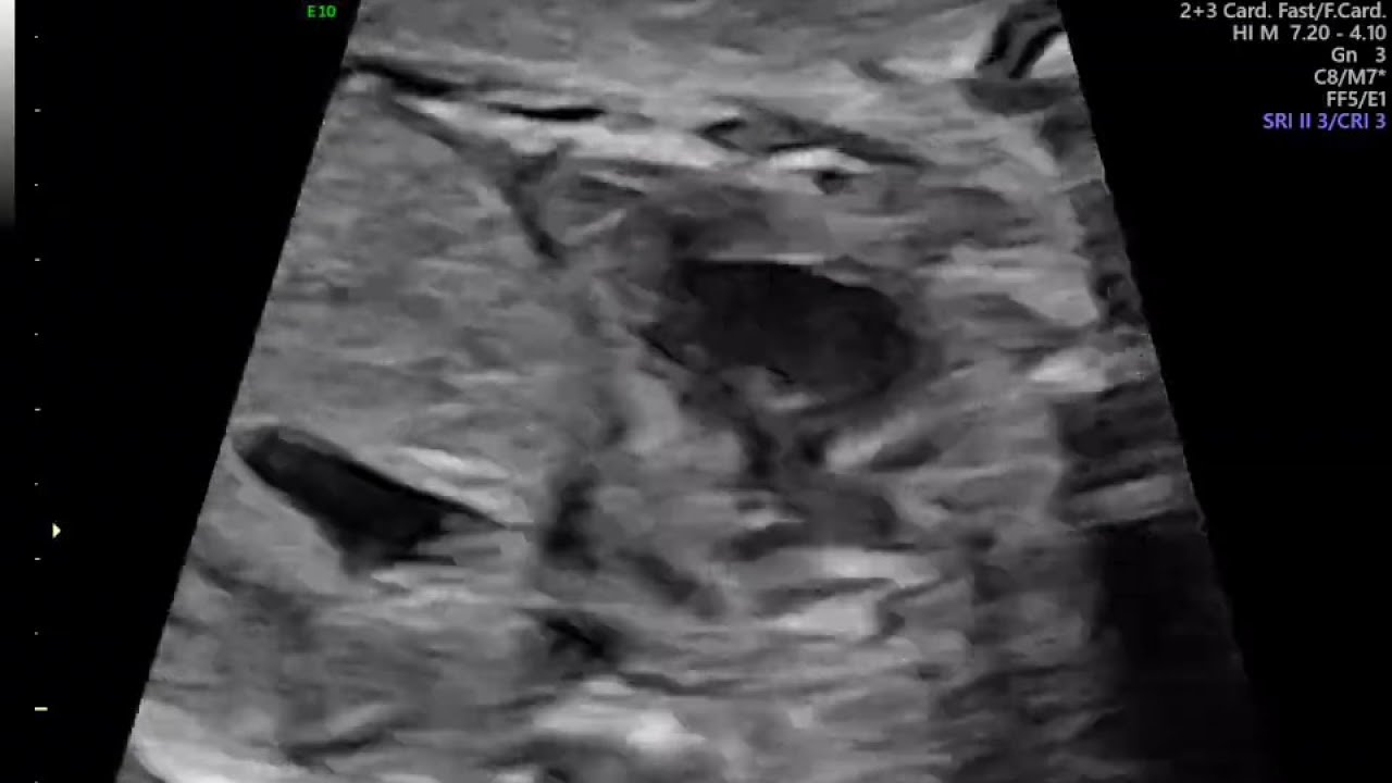 VIAS DE SAIDA DO CORAÇÃO FETAL