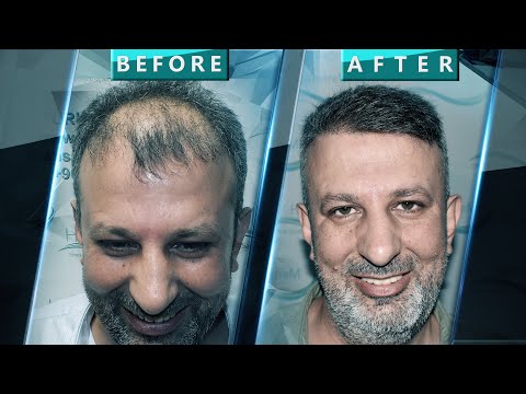 Nihat   Bey işlem sonrası 4. Yıl Türkiye 🇹🇷