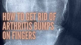 How To Get Rid Of Arthritis Bumps On Fingers