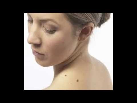 Lentiggine le opzioni di trattamento