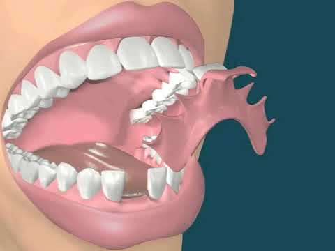 Dental Video of Provisional Single Tooth Lower without clasp - The Tooth