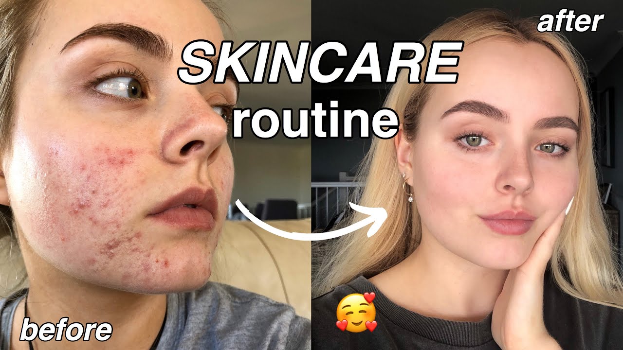 CURRENT SKINCARE ROUTINE | HOW I FADED MY ACNE SCARS | Conagh Kathleen