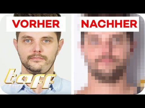 €10,000 cosmetic surgery! Alopecia areata in the beard | SOS - Beauty rescuers on duty | taff