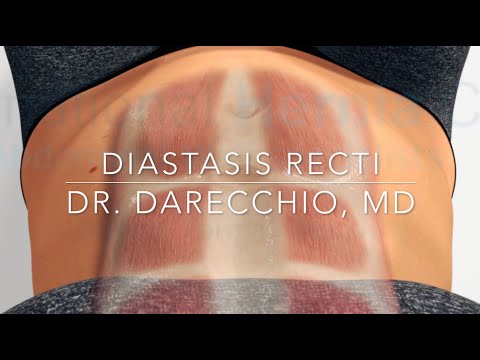 Does Diastasis Recti exercises really close the GAP | Dr. Darecchio