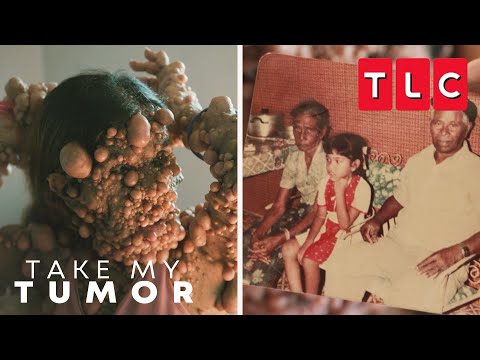 The History of Charmaine's Tumors | Take My Tumor | TLC