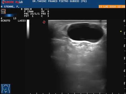 Citochine prostatite abacterial Striscio alla prostata succo di trascrizione