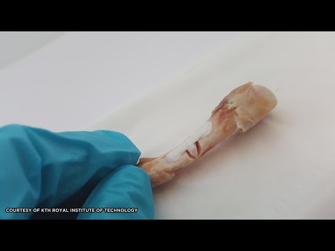 Can Broken Bones Be Healed with Glue?