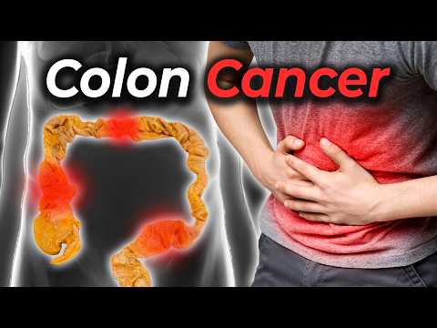 How To Prevent Colon Cancer