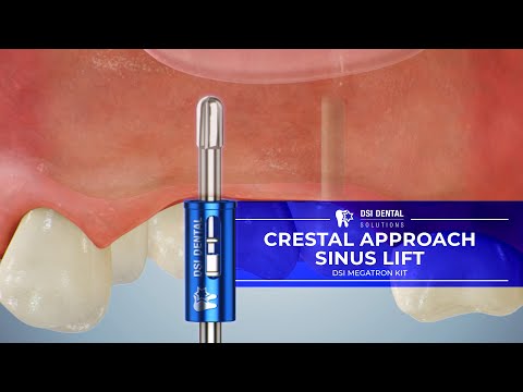 Crestal Approach Sinus Lift -  Dr. Gustavo Yatzkaier Protocol (Megatron kit)