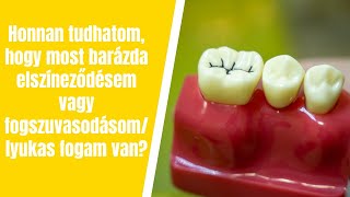 Barázda elszíneződés vagy lyukas fog?