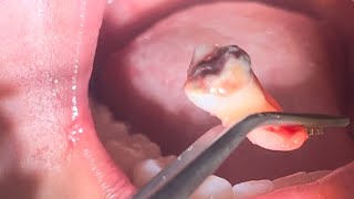 Rotten wisdom tooth removal