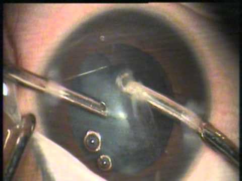 Surgical Management Of Pediatric Cataract