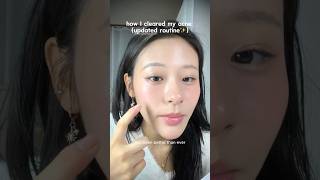 Download lagu *not sponsored* how I cleared my acne (updated routine)✨ mp3 Download lagu *not sponsored* how I cleared my acne (updated routine)✨ mp3