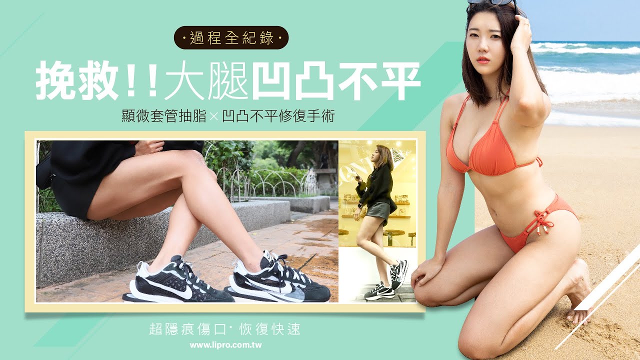 抽脂凹凸不平，該怎麼辦? ｜顯微套管抽脂二次修復全紀錄