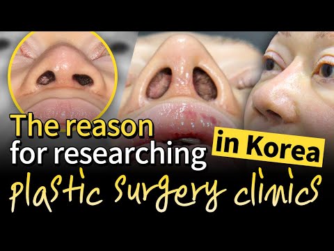 ✨💜REAL REVIEW: Revision rhinoplasty in Korea with Dr.Kim Han-Jo after a failed surgery in the U.S.✨💜