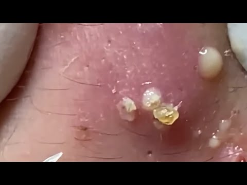 Big Cystic Acne Blackheads Extraction Blackheads & Milia, Whiteheads Removal Pimple Popping 