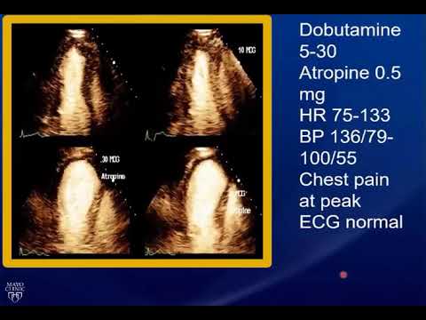 Dobutamina Isquemia Lateral