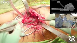 Dr. Stefan Kreuzer performing Direct Anterior Approach Total Hip Arthroplasty - 2023 IMACx