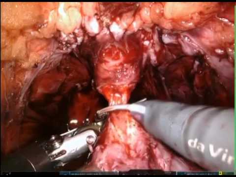 Bilateral Nerve Sparing Robotic Radical Prostatectomy