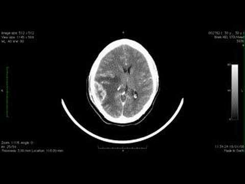 Trichomonas Prostatitis MRT der Prostata und Blase
