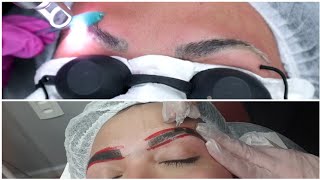 MINHA SESSÃO DE DESPIGMENTAÇÃO DE SOBRANCELHA A LASER E  NOVA MICROPIGMENTAÇÃO SHADOW