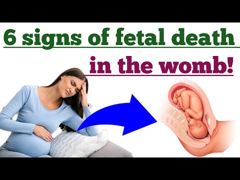 6 Signs of fetal death in the womb and How to prevent it | Stillbirth signs and prevention