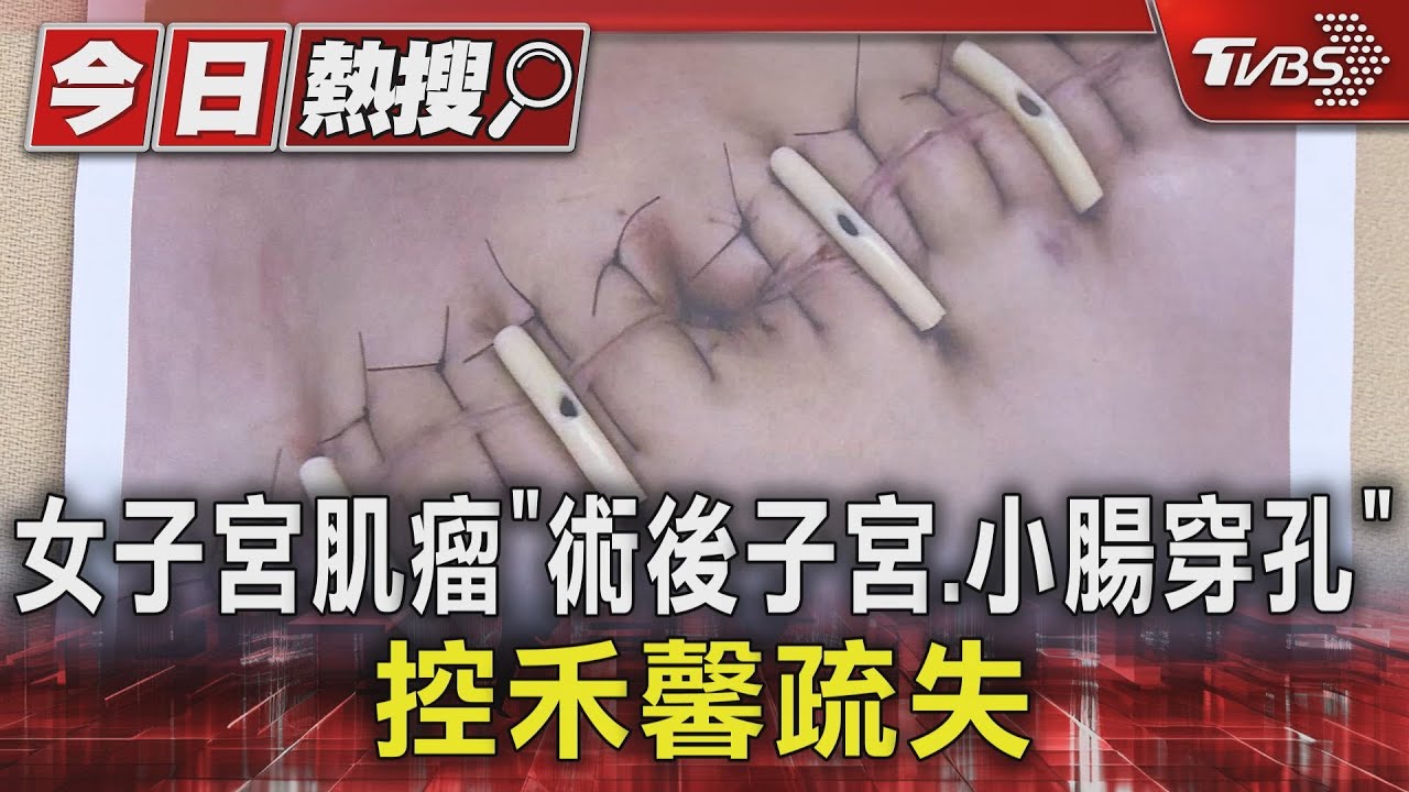 女子宮肌瘤「術後子宮、小腸穿孔」　控禾馨疏失