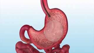 Orbera Non-Surgical Gastric Balloon Removal