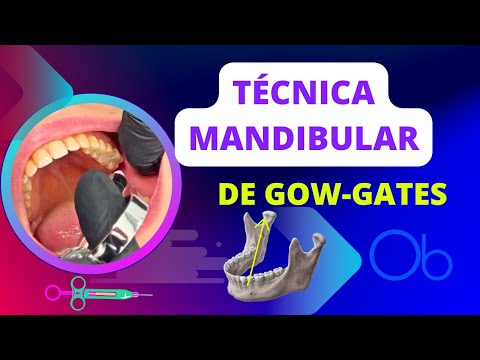 Técnica Mandibular de Gow-Gates