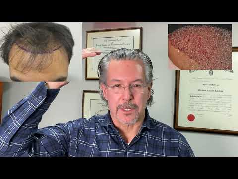 Fantastic hair transplant result 13 months, 3050 grafts in 40 year old Indian by Dr. Lindsey | VA thumbnail