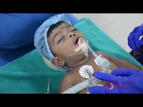 Palatoplasty Surgery