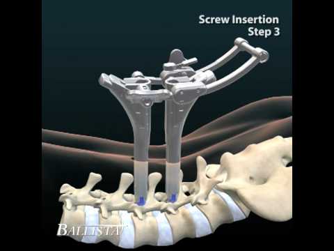 Arthrose des Hüftgelenks Drogeninjektionen Arthritis Gelenke Gelenke der Hände und Füße
