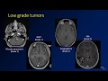 Imaging brain tumors - 4 - Other low grade gliomas