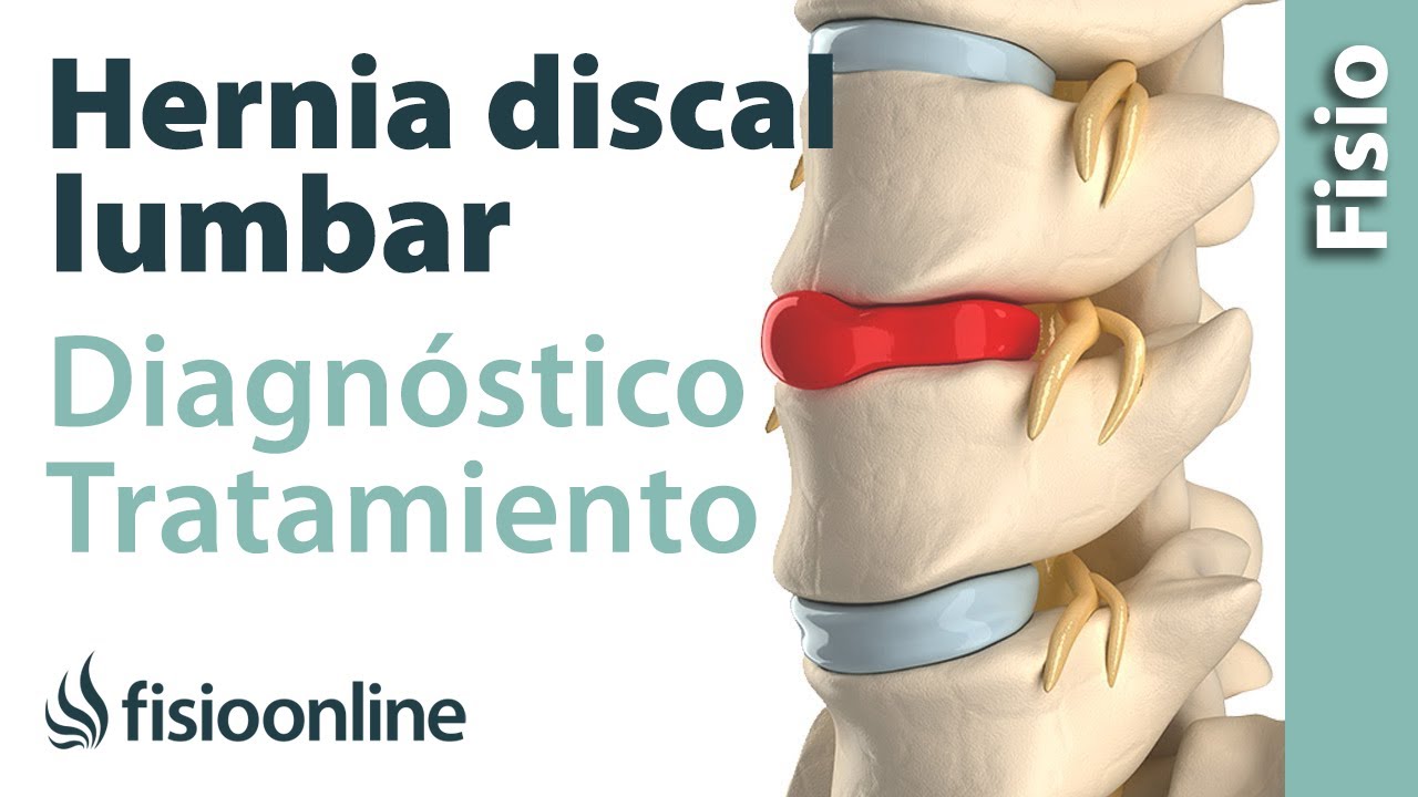 Hernia discal lumbar