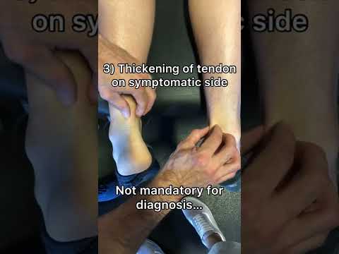 4 Keys to Diagnosing Achilles Tendinopathy