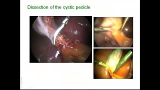 preview picture of video 'Laparoscopic cholecystectomy - surgical anatomy'