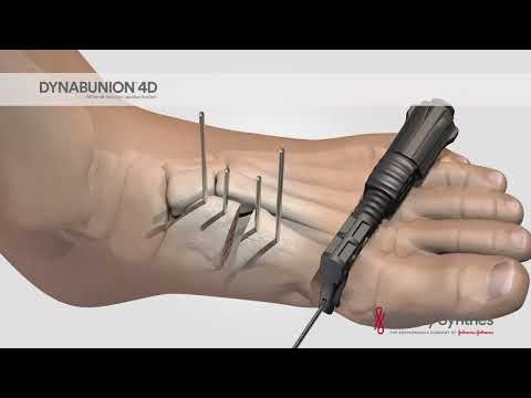 DYNABUNION™ 4D Minimal-Incision Lapidus System - Surgical Animation