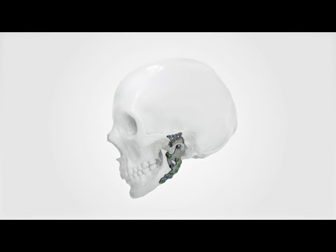 IPS Implants® TMJ Prosthesis