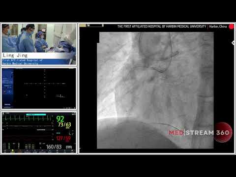 PCI to RCA CTO With Antegrade Approach And Retrograde Approach For Backup Plan