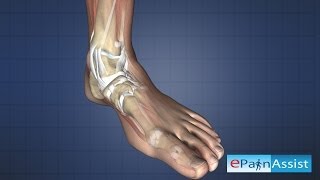 Causes of Ankle Joint Pain: Bursitis, Sprain, Tendonitis, Dislocation, Fracture