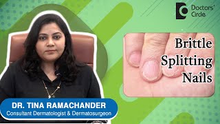SPLIT NAILS | Causes, Prevention & Treatment - Dr.Tina Ramachander | Doctors