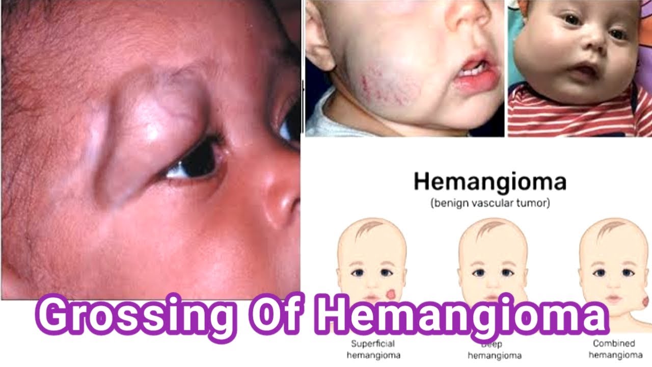How To Do Gross Hemangioma  Specimen।। #grossing#hemangioma#Pathology