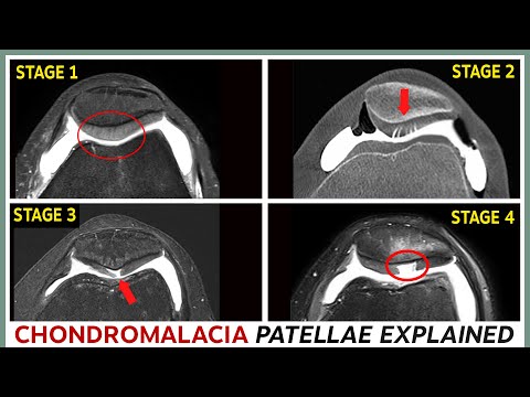 Chondromalacja rzepki – 4 etapy i ich leczenie – wyjaśnienie