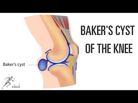 Schemen Behandlung von Osteoarthritis des Knies Medizinprodukt der Osteochondrose
