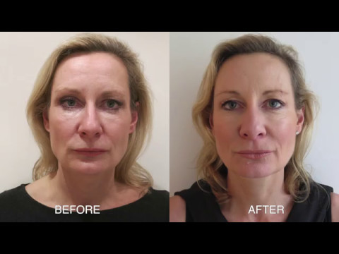 A CSC Patient Talks About Her Silhouette Soft Treatment & The Results